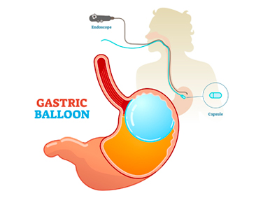 Gastric Balloon Placement for Weight Loss.jpg mission gastro hospital